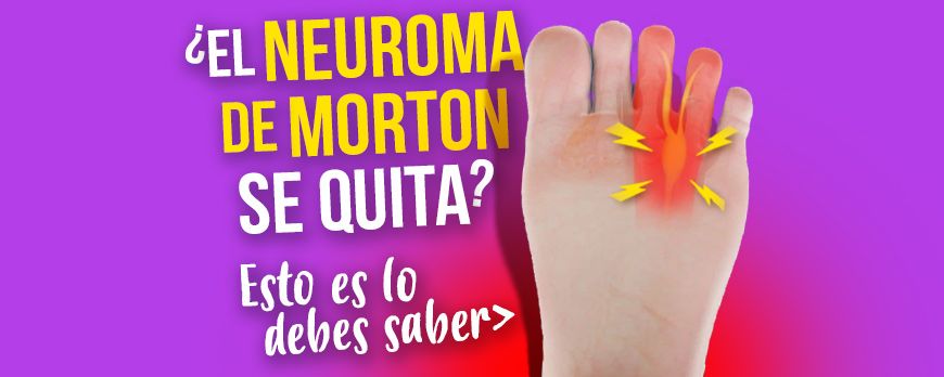 ¿El Neuroma de Morton se quita? Esto es lo que debes saber