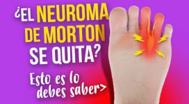 O Neuroma de Morton desaparece? Isto é o que você deve saber